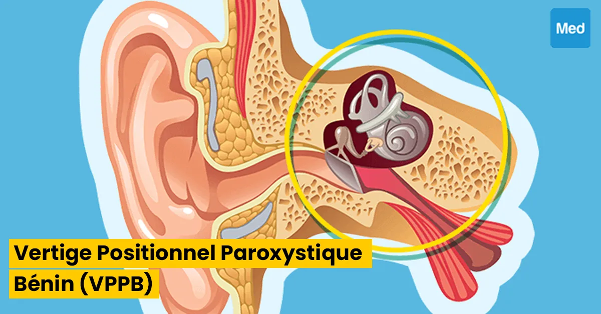 Vertige Positionnel Paroxystique Benin (VPPB) 
